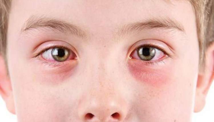 علل سوزش چشم‌ها و درمان آن جیست؟