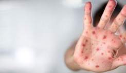 ابتلای ده‌ها هزار فیلیپینی به سرخک در سال ۲۰۱۹
