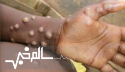 موارد آبله میمونی در طول یک هفته ۷۷ درصد افزایش یافت