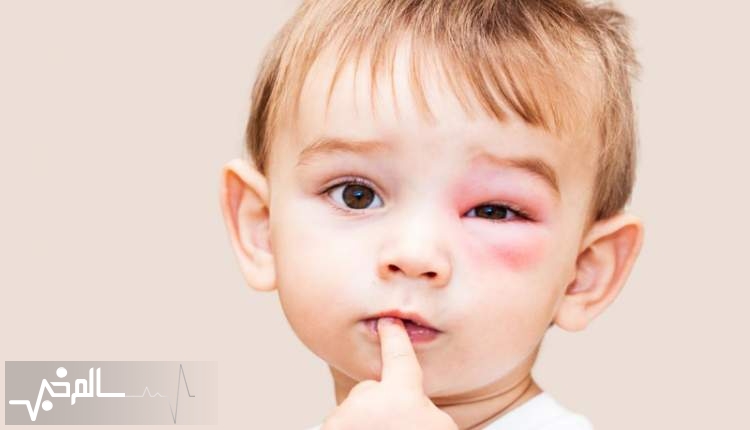  آلرژی یکی از بیماری‌های شایع کودکان است