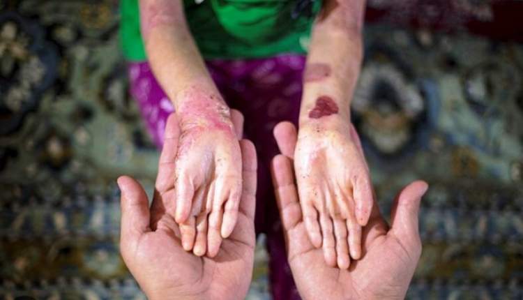 تحویل ۱۱۱ هزار پانسمان تخصصی بیماران پروانه‌ای به معاونت غذا و دارو