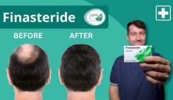 هشدار درباره داروی ریزش مو فیناستراید؛ افسردگی و خودکشی برای مصرف‌کنندگان تایید شد