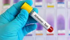 تست خون تشخیص زودهنگام آلزایمر بدون نیاز به اسکن مغز تایید شد تست خون تشخیص زودهنگام آلزایمر بدون نیاز به اسکن مغز تایید شد