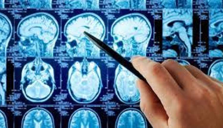 داروی جدید تومورهای مغزی "تینستاموستین" در فهرست داروهای اورفان قرار گرفت داروی جدید تومورهای مغزی "تینستاموستین" در فهرست داروهای اورفان قرار گرفت