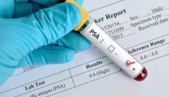 روند افزایشی سرطان پروستات در ایران