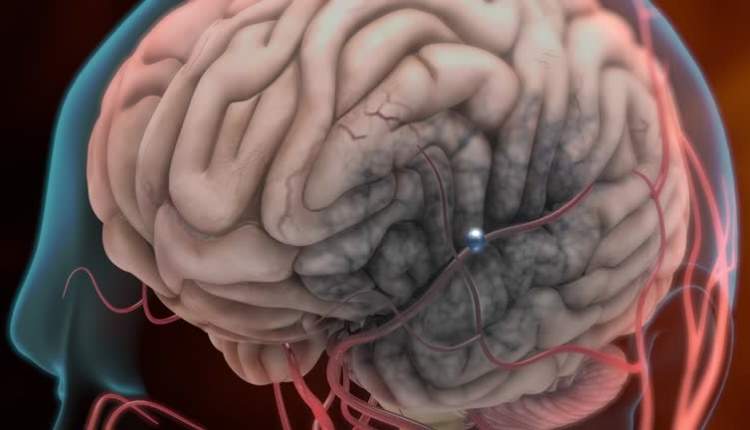 هشدار درباره جهش قیمت داروهای سکته مغزی؛ درمان تعطیل می‌شود