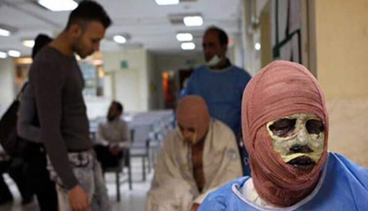 آمار سوختگی در ایران ۸ برابر میانگین جهانی است